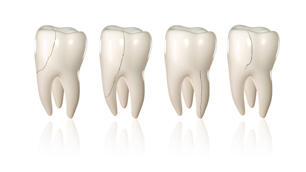 cracked teeth, chipped tooth, endodontist