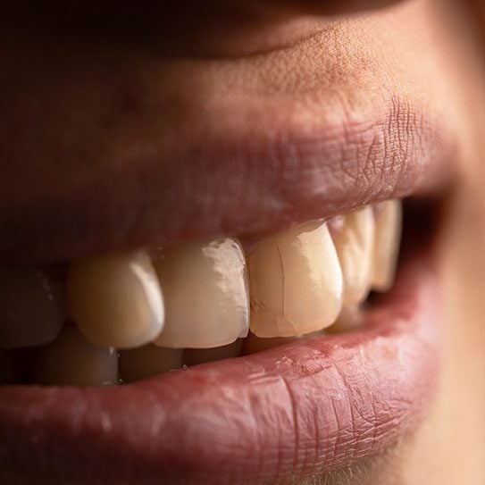 cracked tooth repair sterling